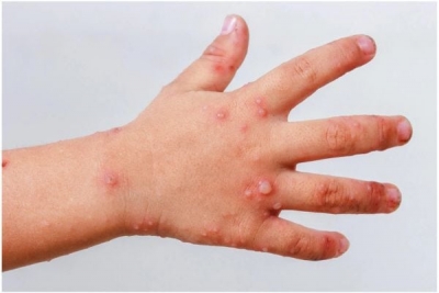 Coxsackie, δηλαδή;