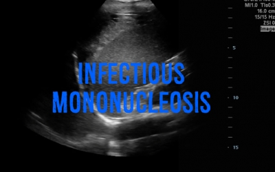 Λοιμώδης μονοπυρήνωση - Ιός EBV και όχι μόνο...